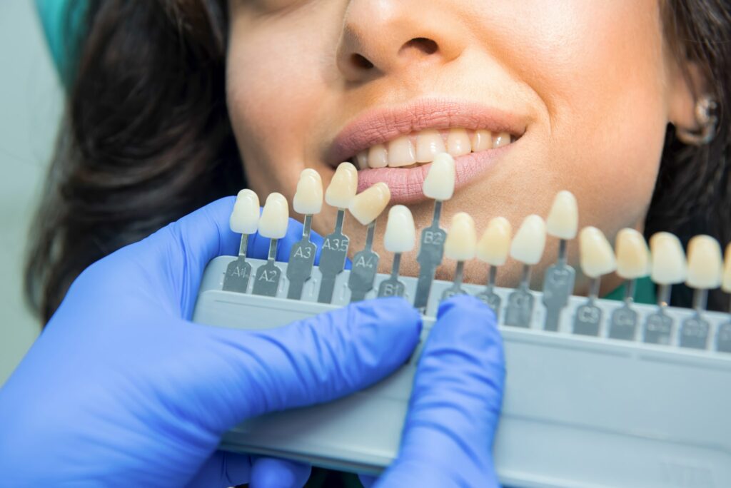 Tooth whitening chart